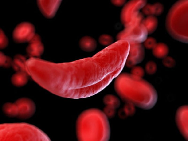 Sickle Cell Disease