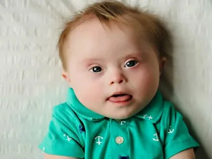 Genetic disorder Down syndrome