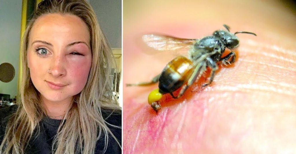 What Happens When a Bee Stings You: Complete Explanation for All Ages 1 Add a heading 5 1