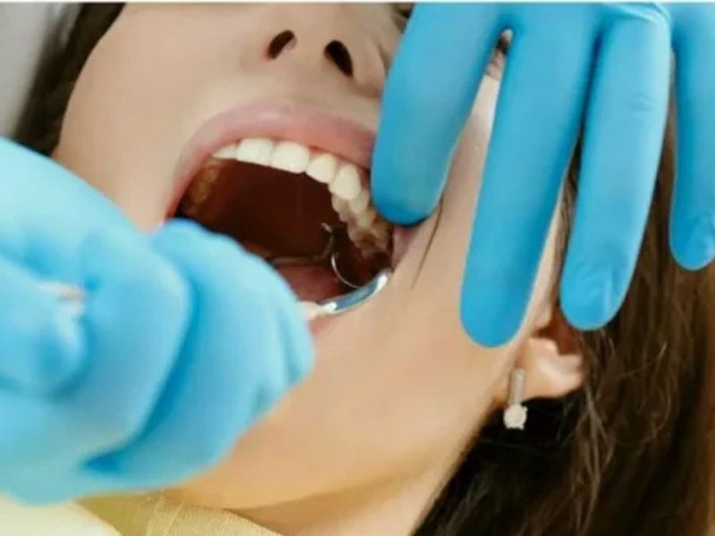 Removing wisdom teeth