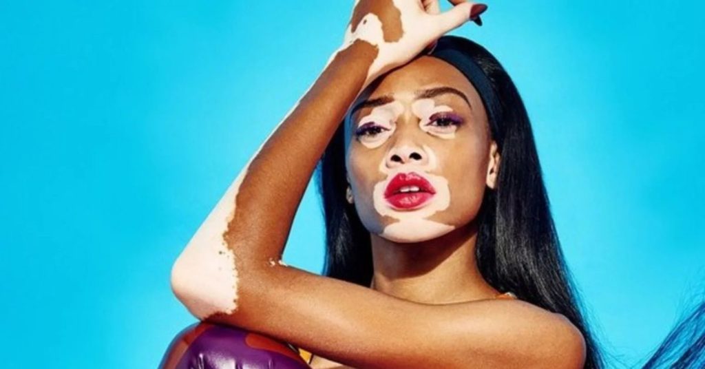 Effective Guide to White Patches on Skin: Causes, Care, and Treatment white patches on skin white patches on skin