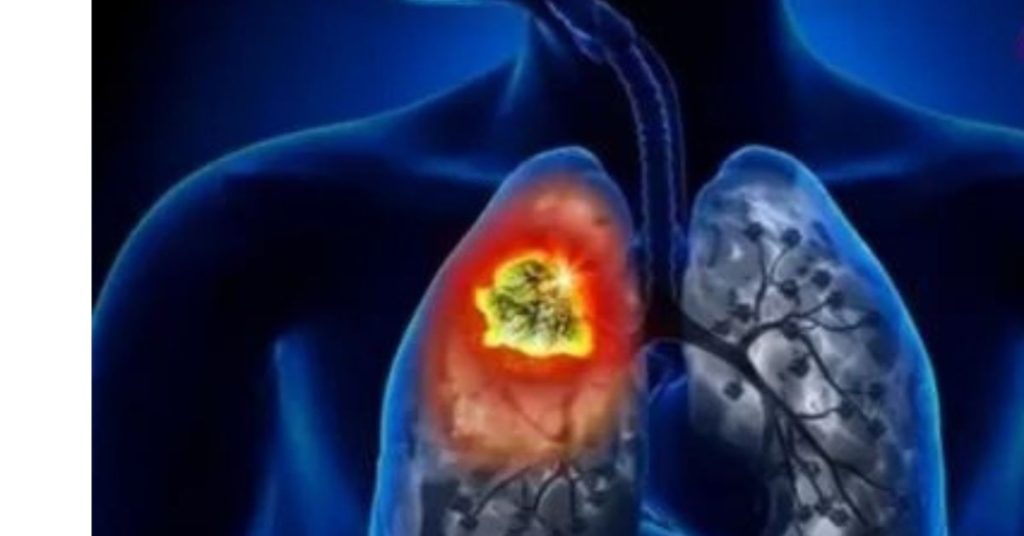 World Lung Cancer Day: An Essential Step Towards Better Health World Lung Cancer Day World Lung Cancer Day