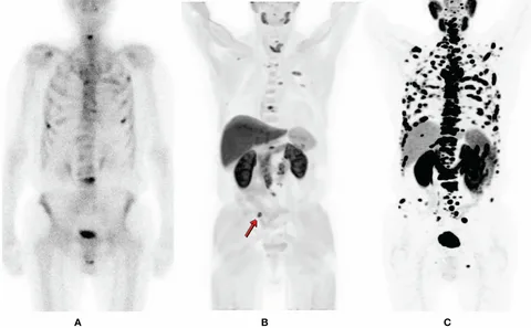 How PET Scan Works: A Deep Dive into the Science and Simplicity 1 i 52