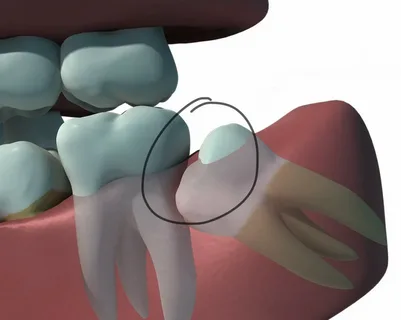 Removing Wisdom Teeth: A Complete Guide for Students and Adults 1 i 58
