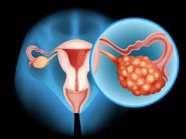 Symptoms of Ovarian Cancer