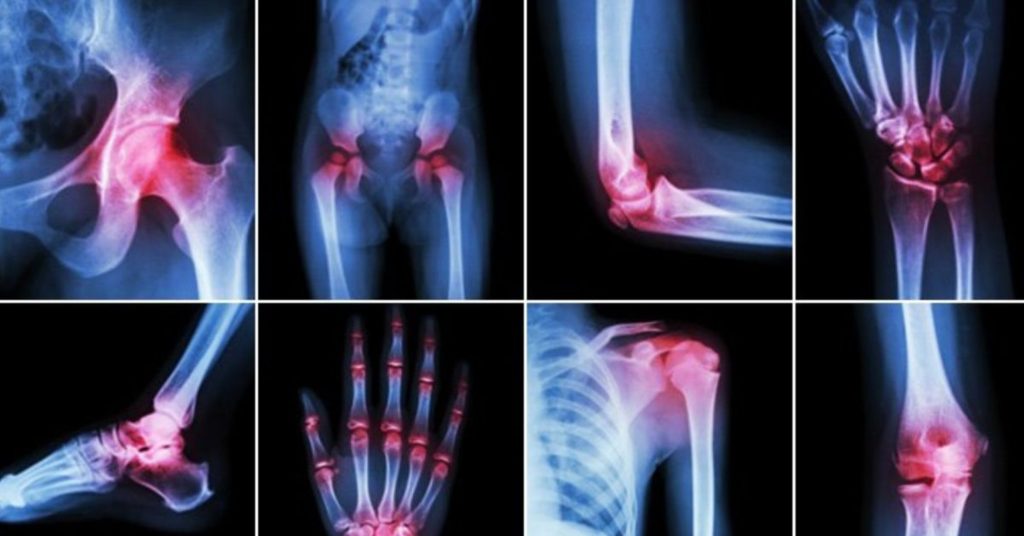 Arthritis: A Complete Guide to Understanding, Preventing, and Managing Joint Pain Arthritis Arthritis