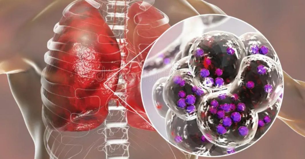 Understanding Legionnaires Disease