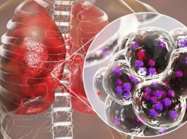 Understanding Legionnaires Disease
